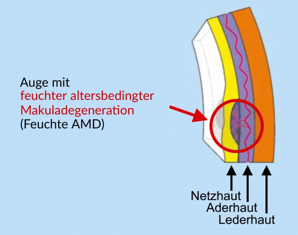 Feuchte Makula